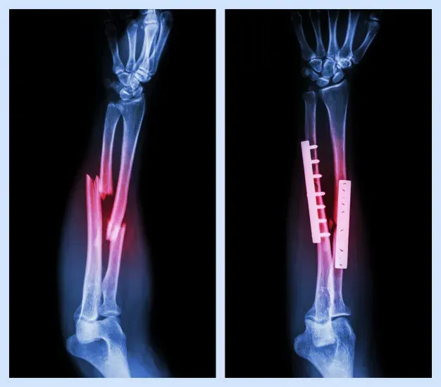 Tratamiento de fracturas